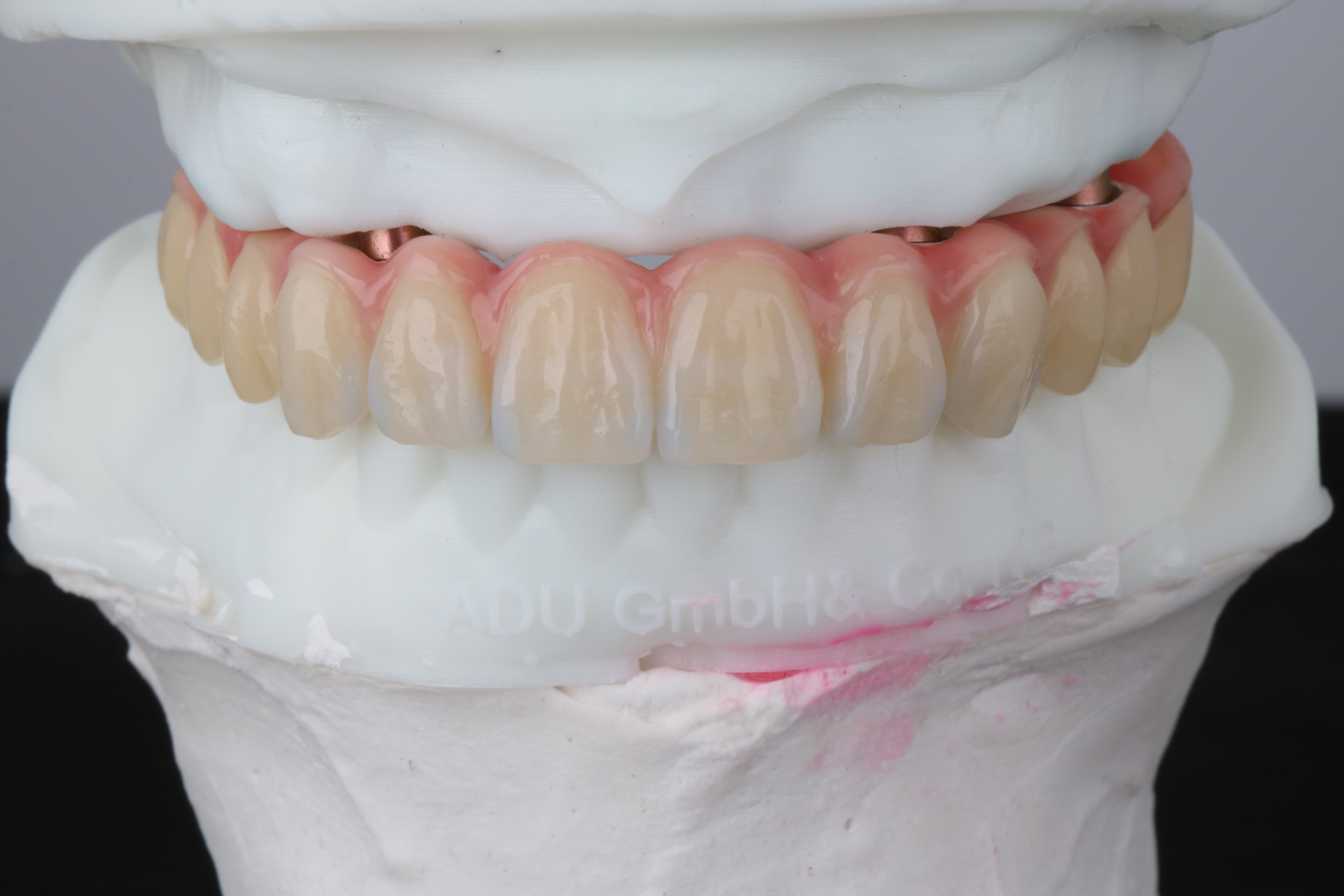 Implantatgetragene Sofortversorgung als verschraubtes Provisorium aus Hochleistungspolymer von ADU-Dental