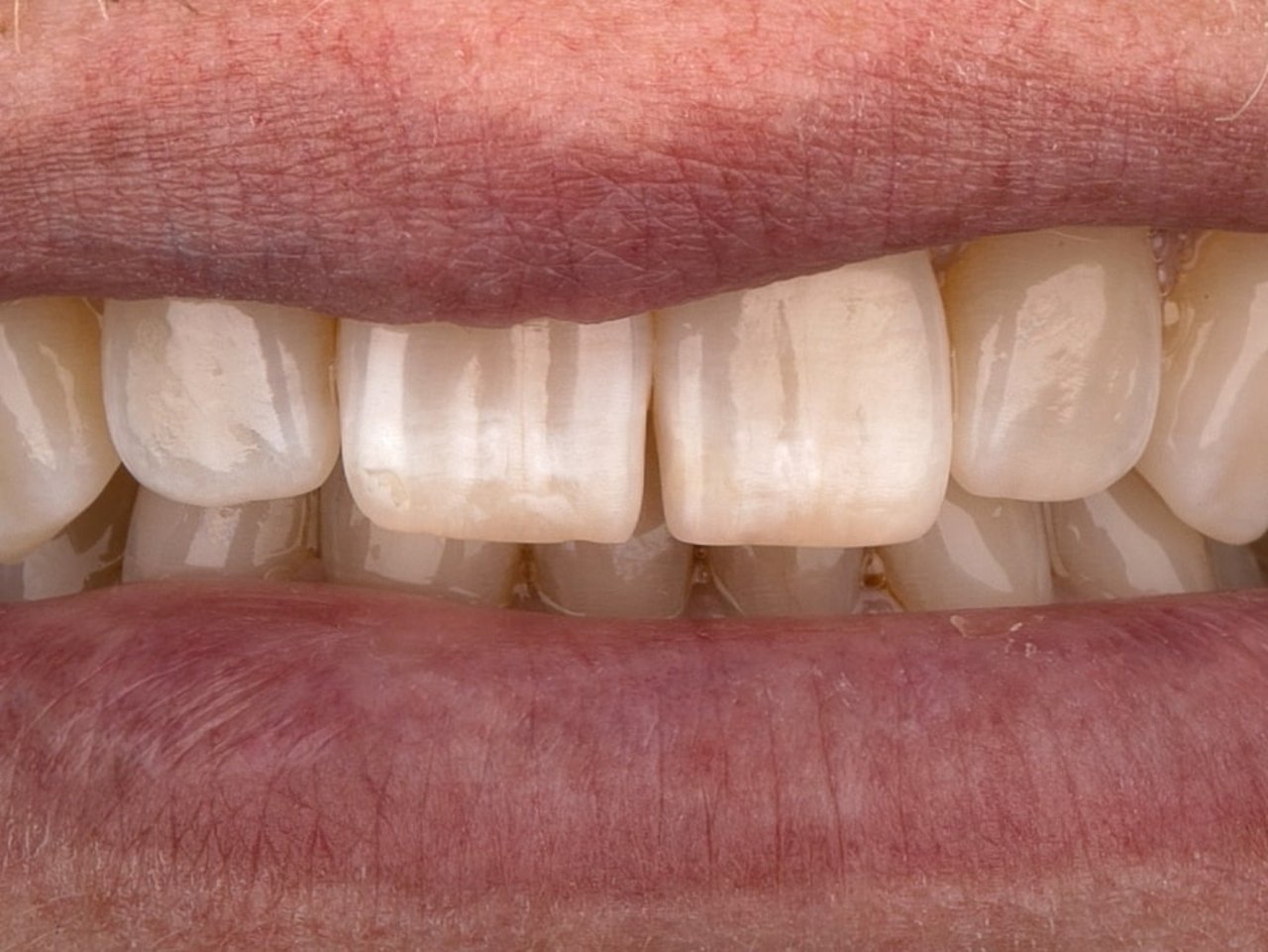 Dentalfoto mit Lippenhalter