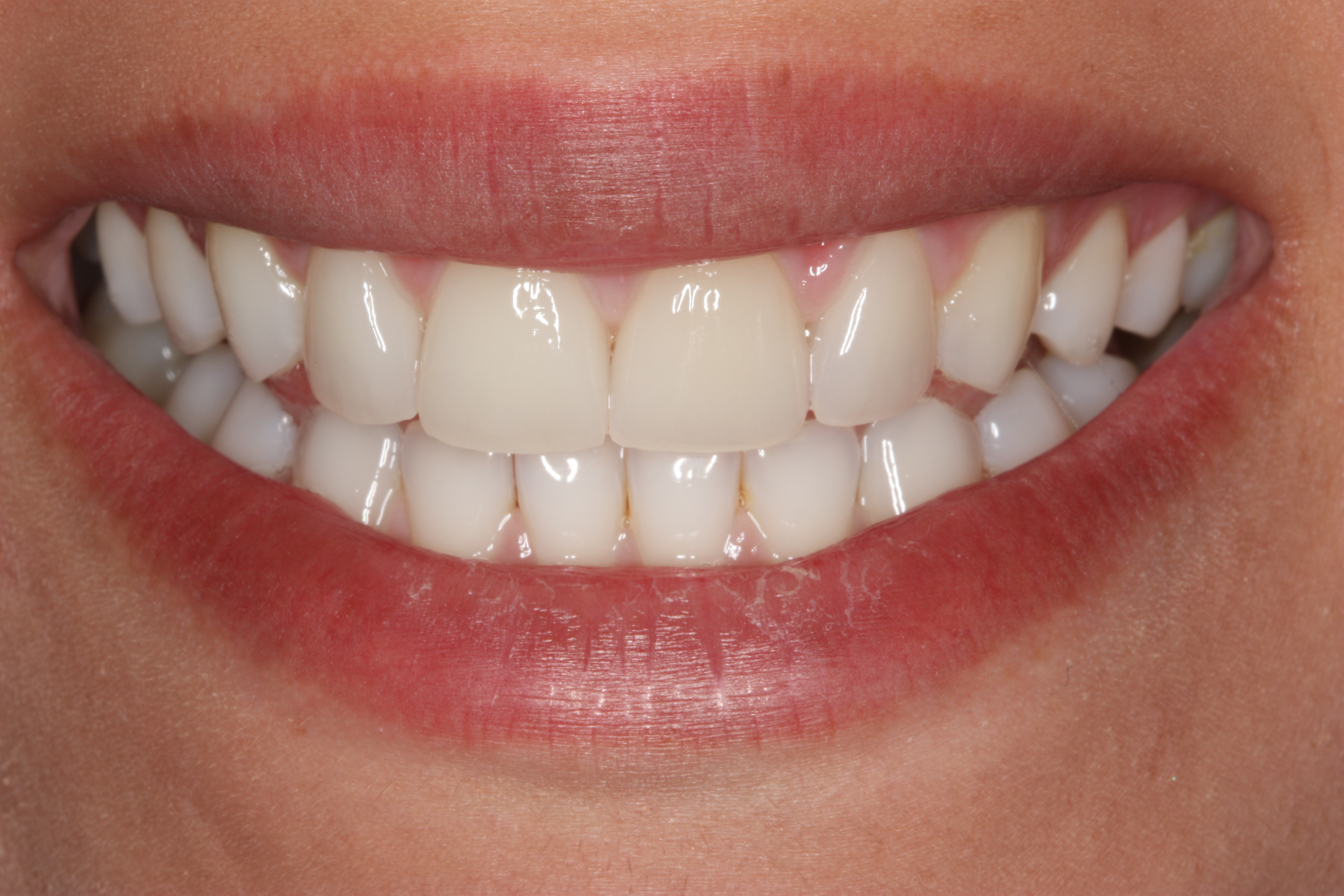 Veneers – Nachher
