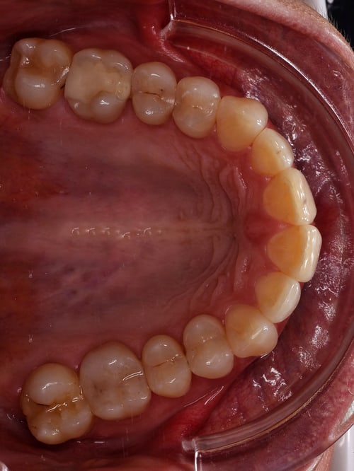 Dentalfoto: Okklusalaufnahme