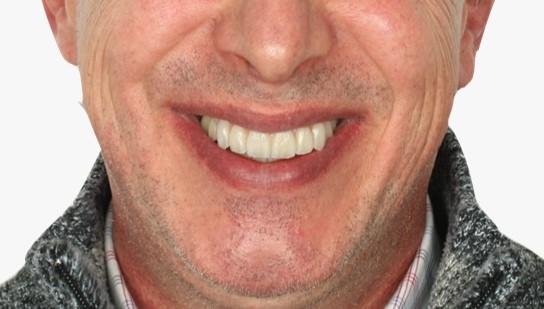 Verschraubte Versorgung nach Einsatz der geteilten Bohrschablone von ADU-Dental