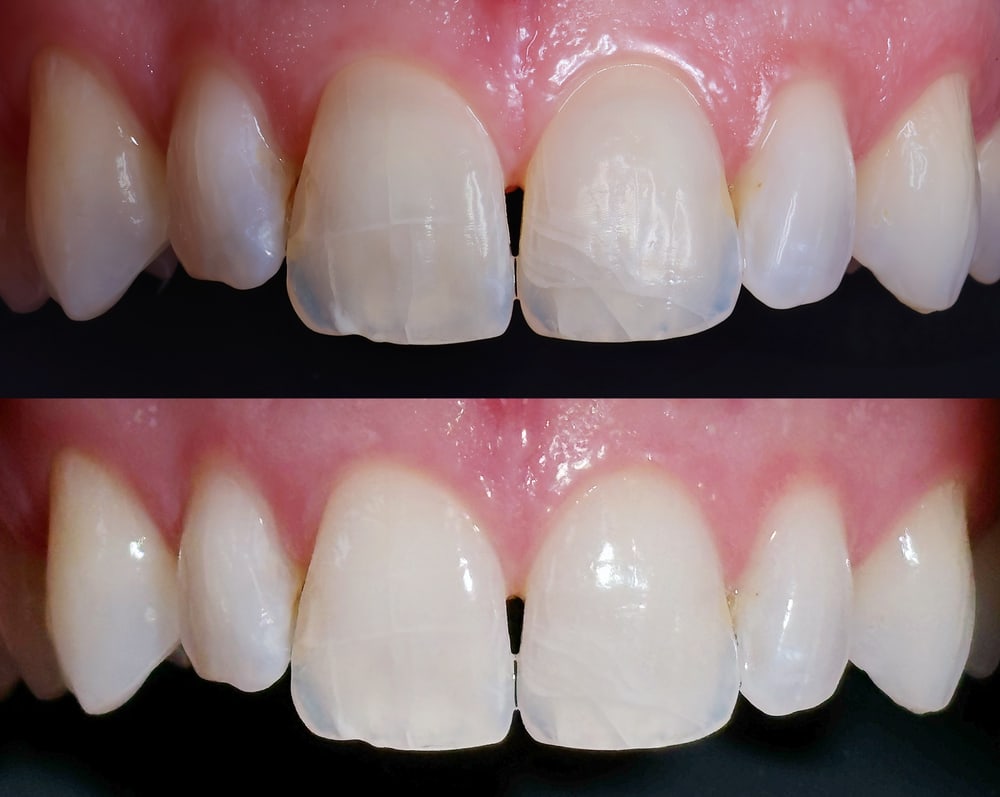 Vergleich: Frontzähne mit dem Dental-Kit (oben) und mit dem iPhone 15 (unten) fotografiert