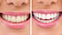 Vorher-Nachher-Vergleich des Zahnweiß, links gelblich, rechts strahlend weiß.