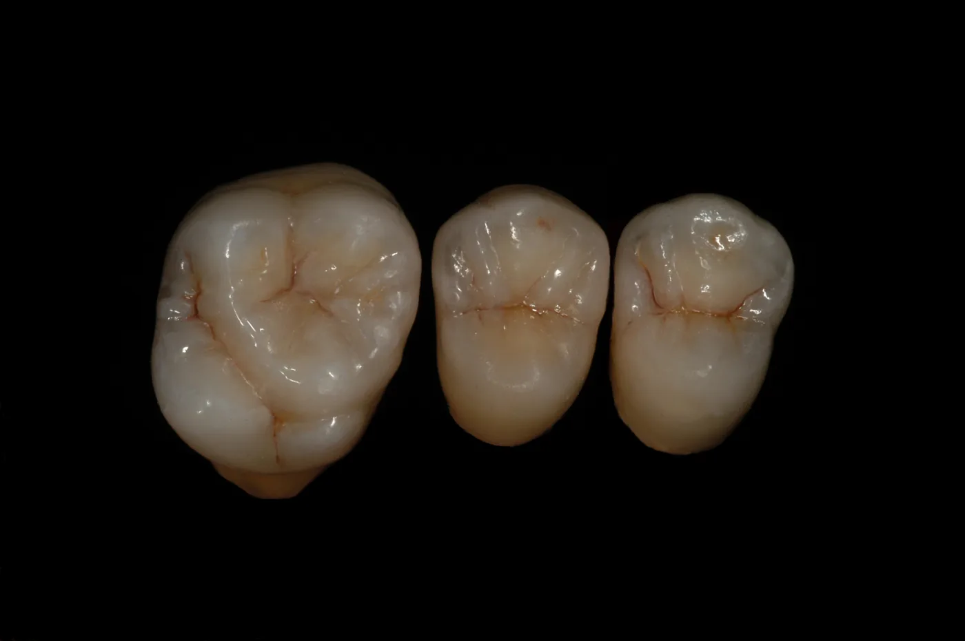 Kronen aus IPS e.max, gefertigt von ADU-Dental