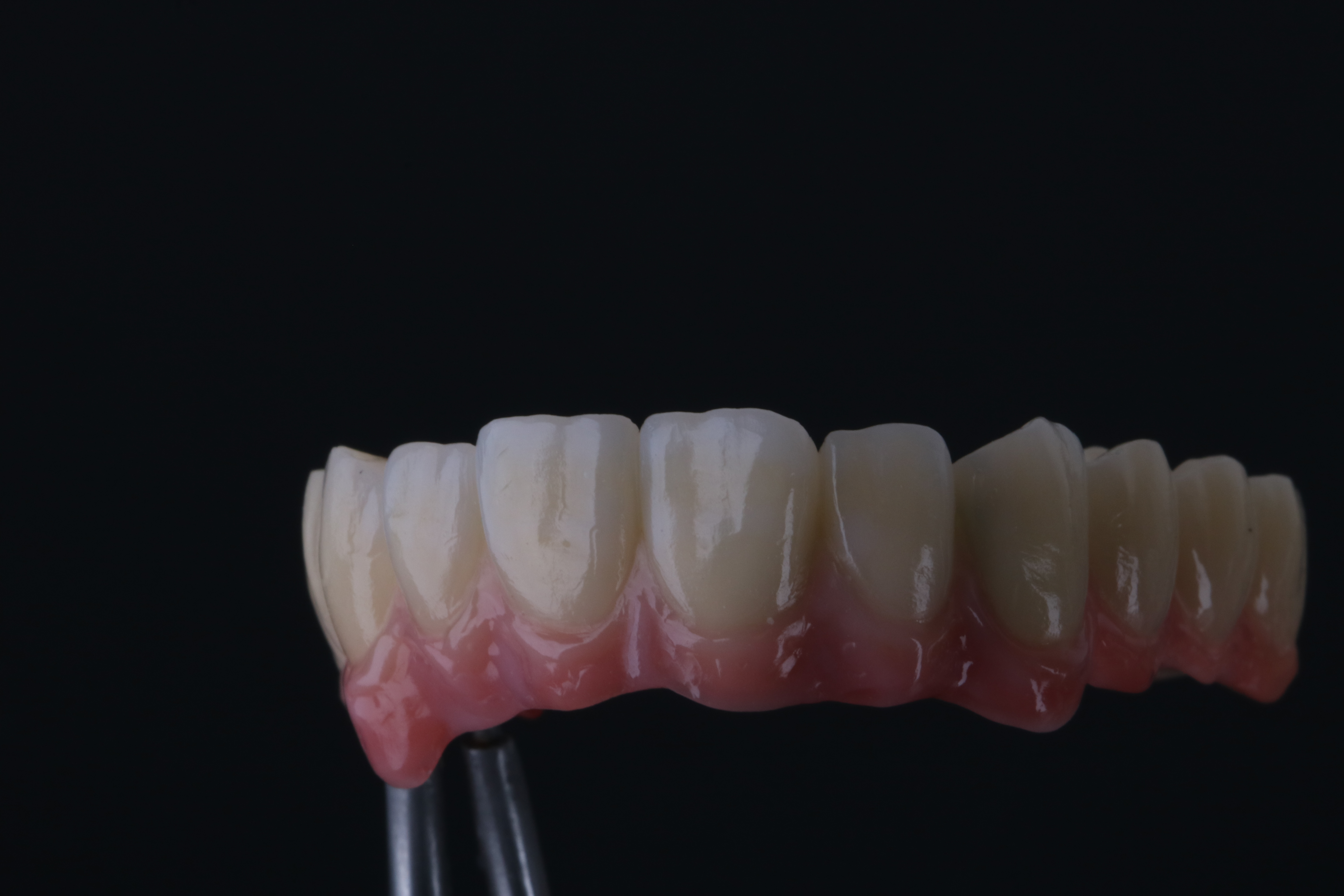 Teleskopversorgung des gesamten Oberkiefers aus Titan, gefertigt von ADU-Dental