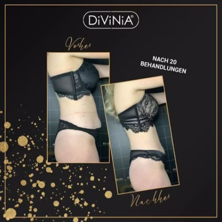 Vorher-Nachher-Vergleich einer Frau in schwarzer Unterwäsche, links "Vorher" und rechts "Nach 20 Behandlungen".
