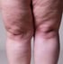 Lipödem Symptome Beine mit unproportionaler Fettverteilung und Schwellung