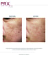 PRX skin rejuvenation before and after in Glendale AZ