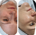 Zwei nebeneinander liegende Fotos eines Gesichts vor und nach einer Hautbehandlung.