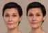 Before and after view of a woman's face demonstrating the benefits of dermal fillers