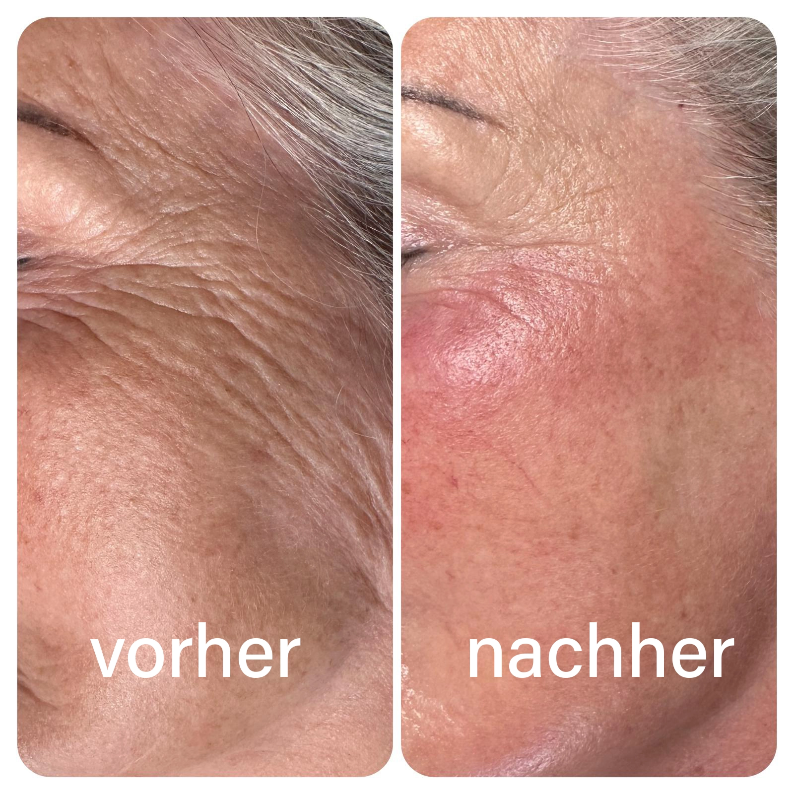 Vorher-Nachher Hautergebnis