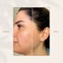 Laser hair removal treatment for smooth and hair-free skin
