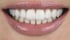 Schöne Zähne mit Veneers