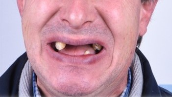 Restbezahnter Kiefer vor der Versorgung über eine geteilte Bohrschablone