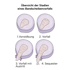 Vier schematische Darstellungen eines Bandscheibenvorfalls: Vorwölbung, Vorfall, Vorfall mit Austritt, Sequester.