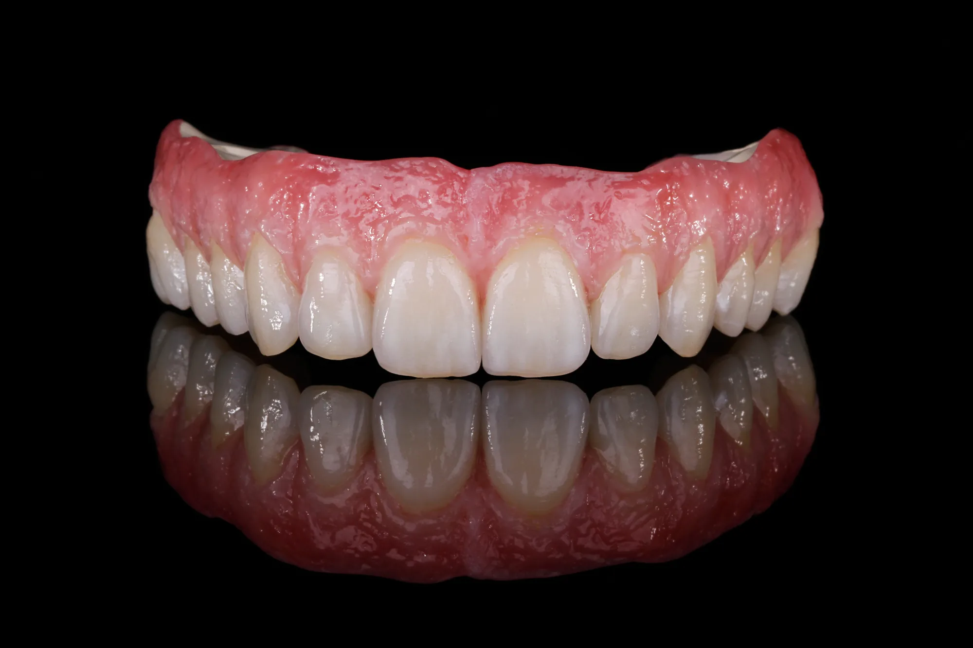 Implantatgetragene Teleskoparbeit für den Oberkiefer auf individuellen Zirkon-Abutments, abnehmbar, von ADU-Dental