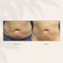 Laser hair removal treatment for smooth and hair-free skin