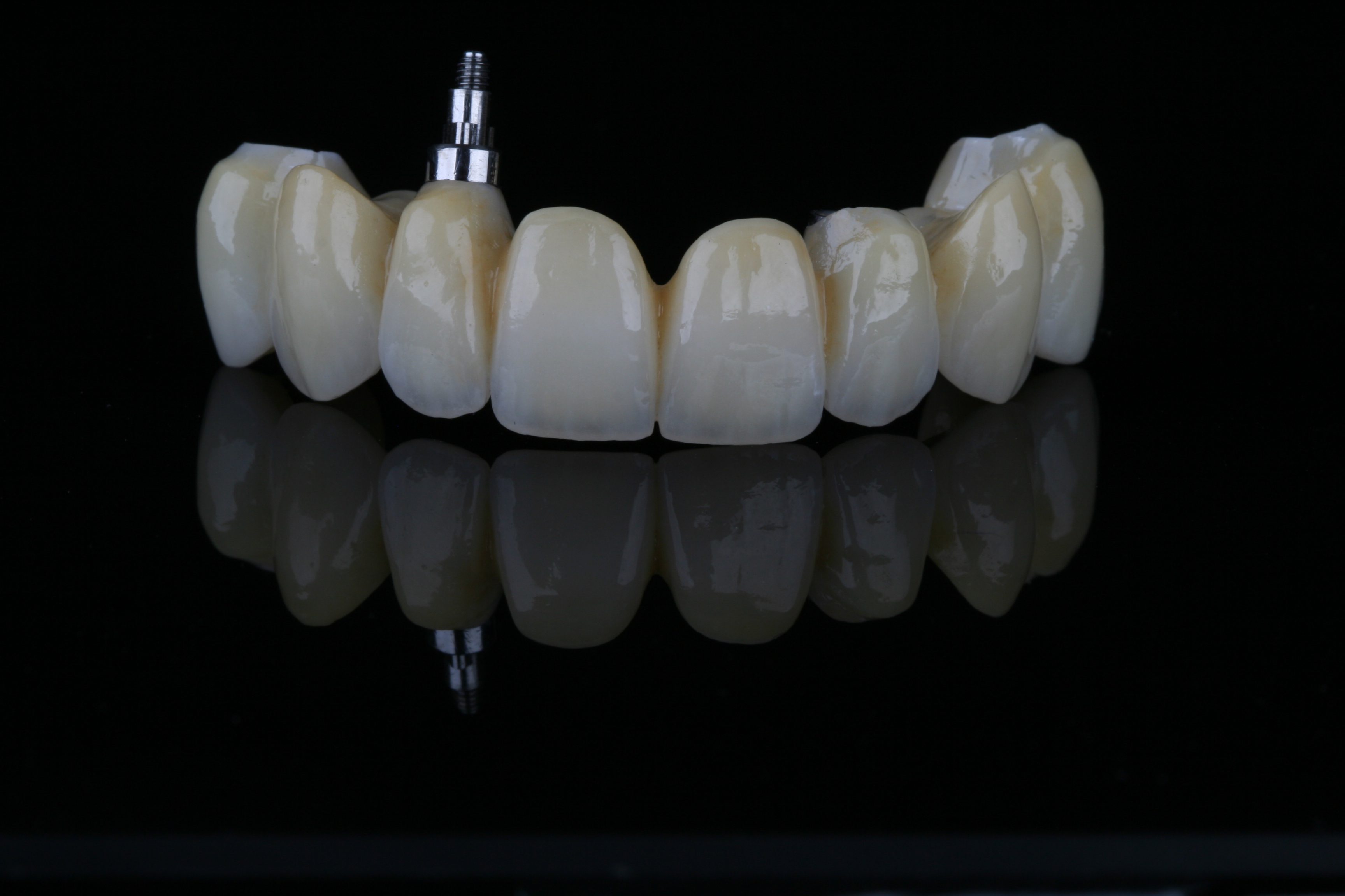 Verschraubte Zirkonbrücke auf Implantaten von ADU-Dental