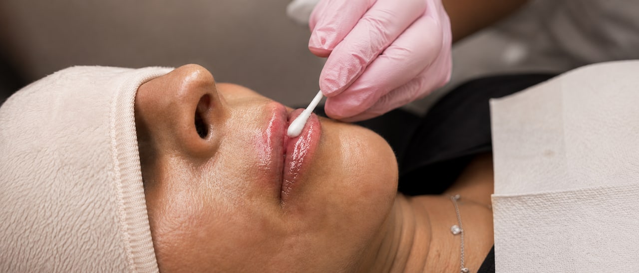 Lippenpflege nach dem Lippenvolumenaufbau bei SWON in Pforzheim