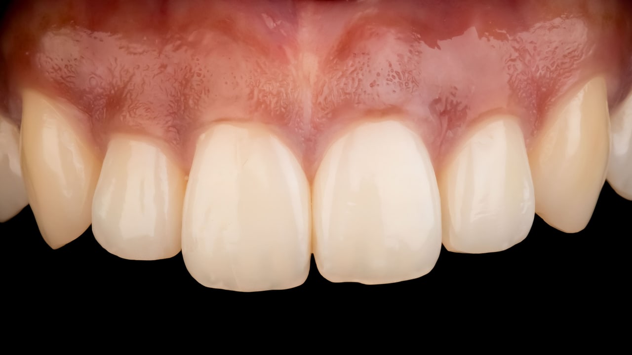 Dentalfoto: Frontzähne vor schwarzem Hintergrund