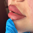Nachher Ergebnis von PMU-Lippen