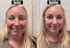 Blonde Frau vor und nach einer kosmetischen Behandlung, mit Text "Vorher" und "Nachher".