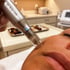 A gloved hand uses an MD Pen RF microneedling device on a person's cheek for a professional skin rejuvenation treatment.