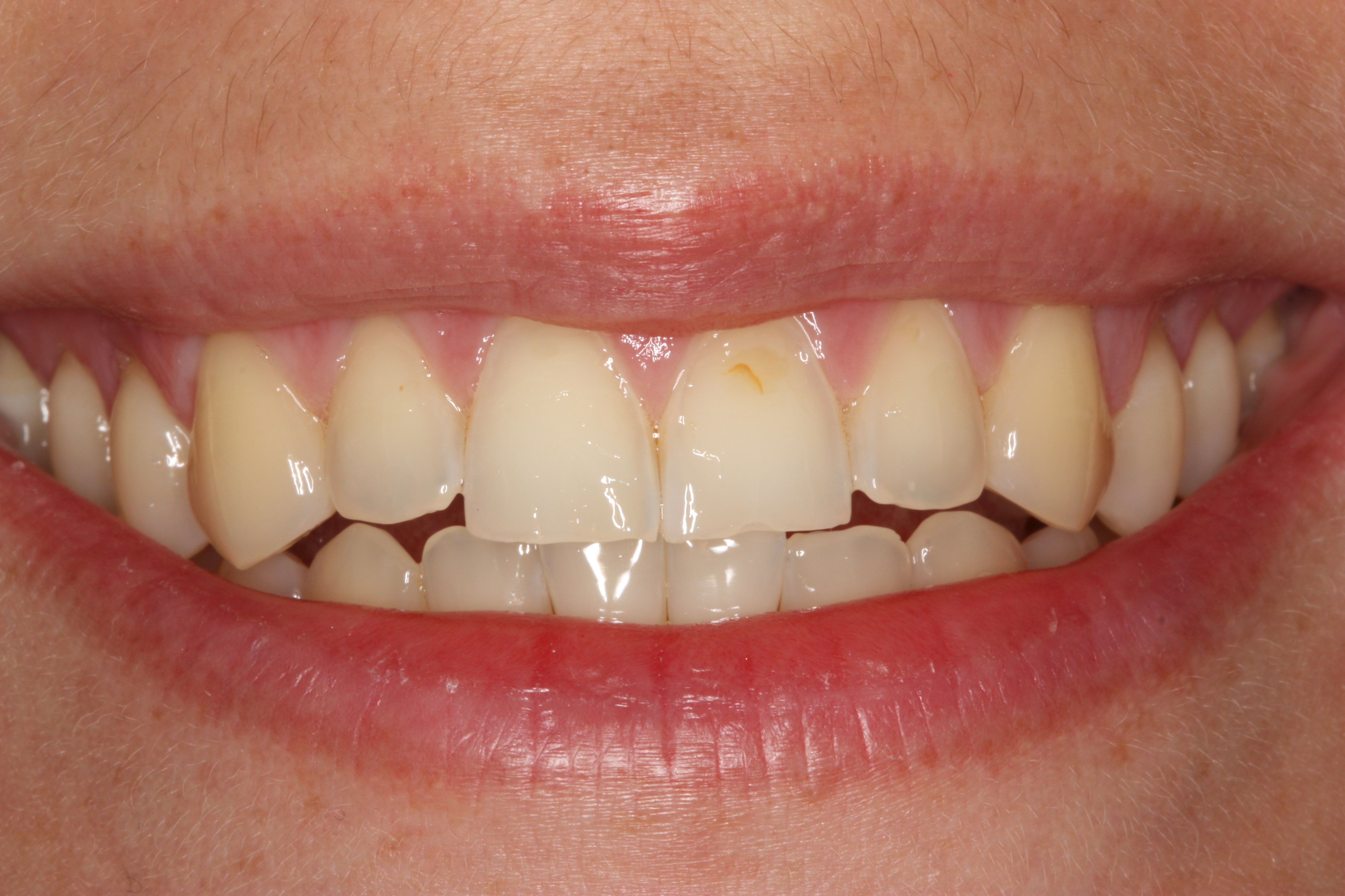 Veneers – Vorher