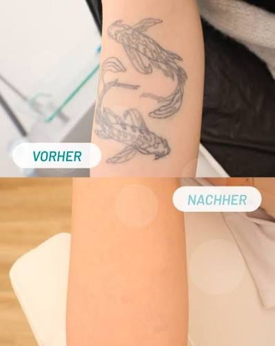 Koi-Tattoo am Unterarm vor und nach der Laserentfernung