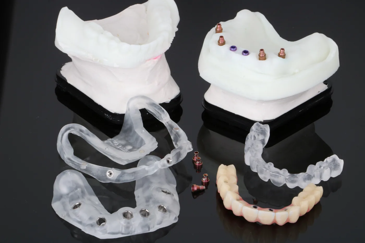 Geteilte Bohrschablone, Modelle und Provisorium für die navigierte Implantation mit Sofortversorgung von ADU-Dental