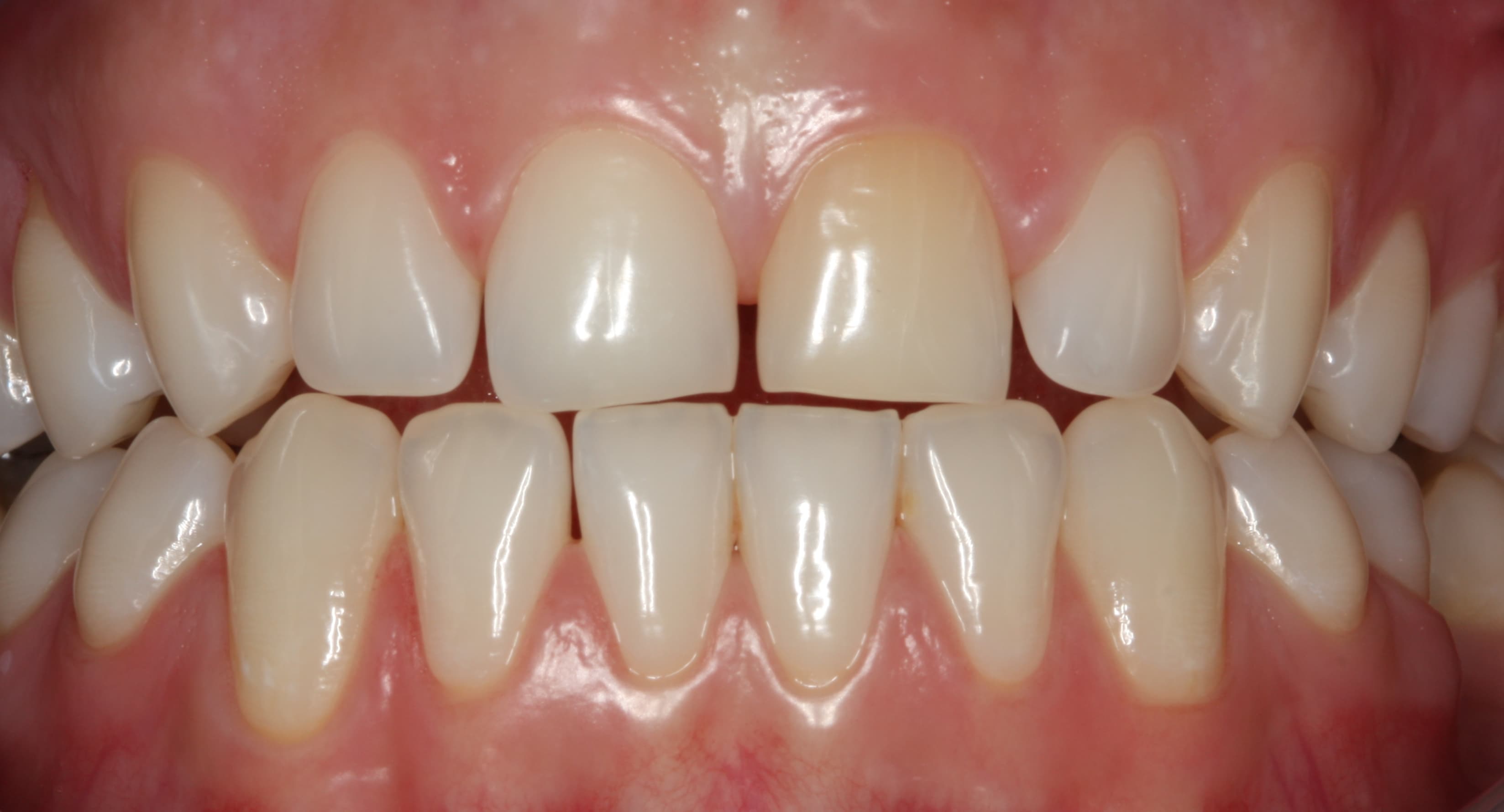 Veneers – Vorher