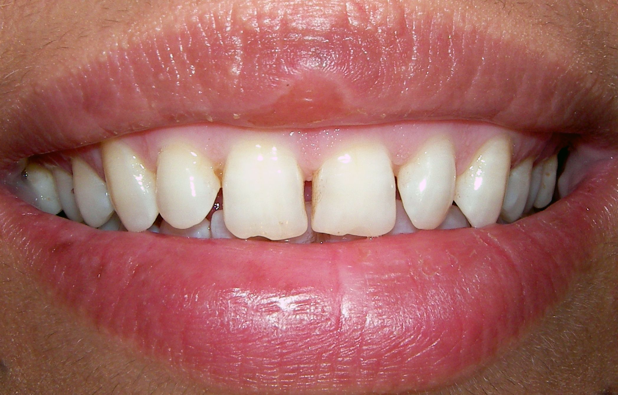 Kronen und Veneers – Vorher