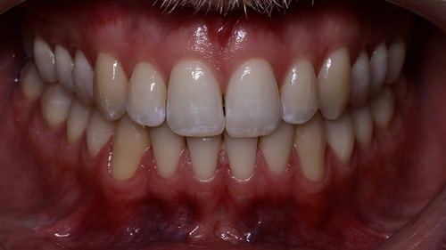 Dentalfoto: Fotostatus frontal mit Lippenhalter