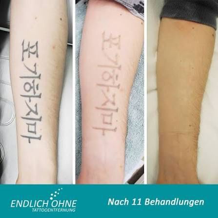Schriftzeichen-Tattoo am Unterarm im Verlauf von elf Laserbehandlungen