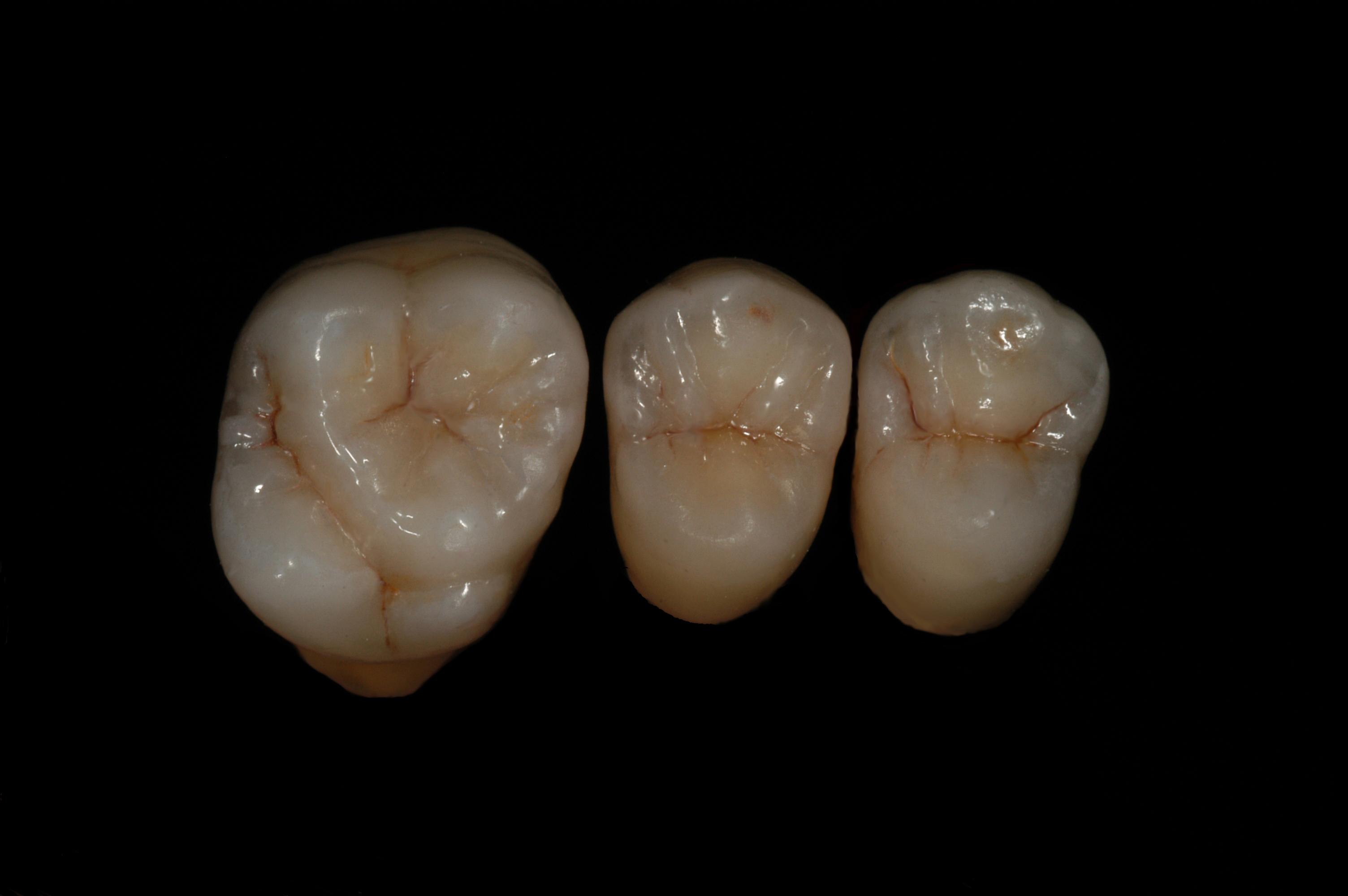 Kronen aus IPS e.max, gefertigt von ADU-Dental
