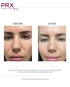 Before and after of PRX serum brightening treatment in Glendale 