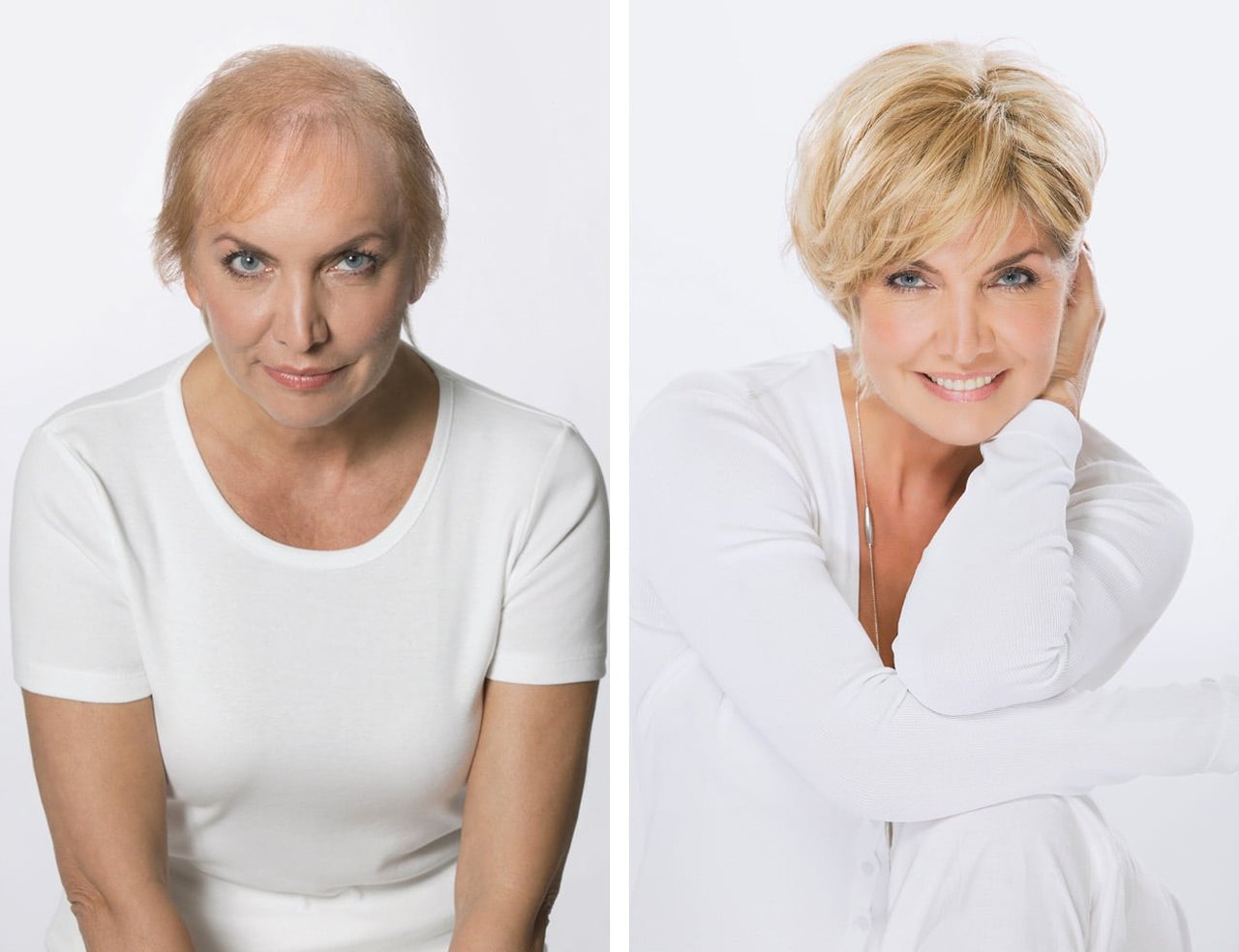 Vorher-Nachher-Ergebnis aus dem Salon – Haarverdichtung