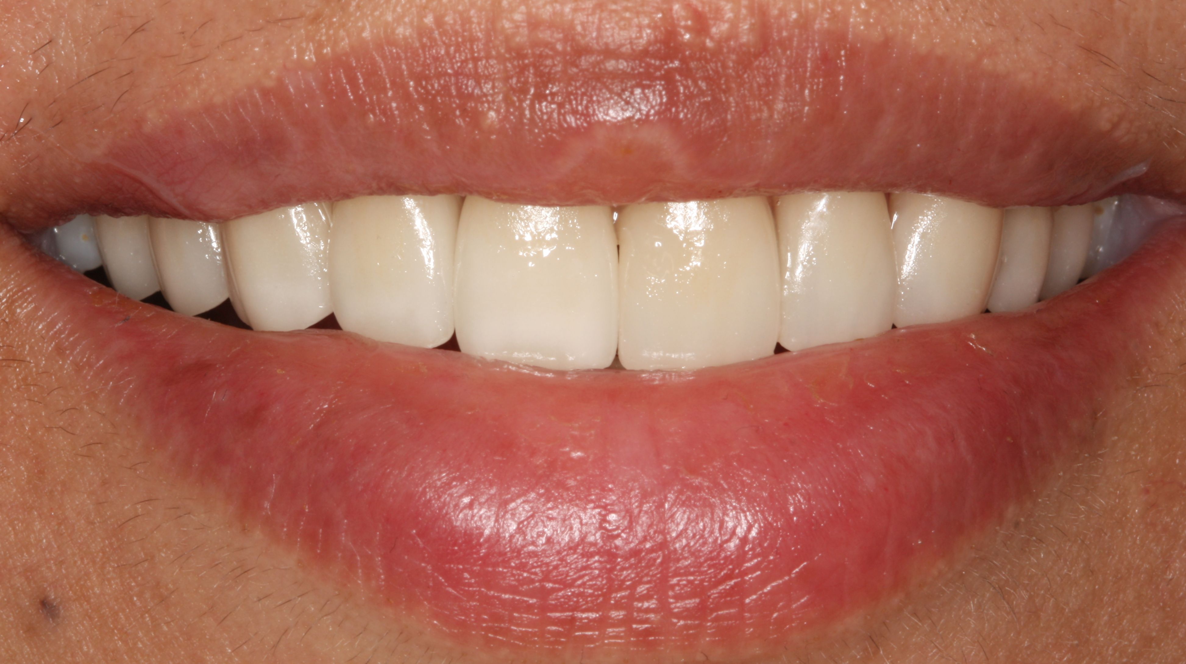 Kronen und Veneers – Nachher