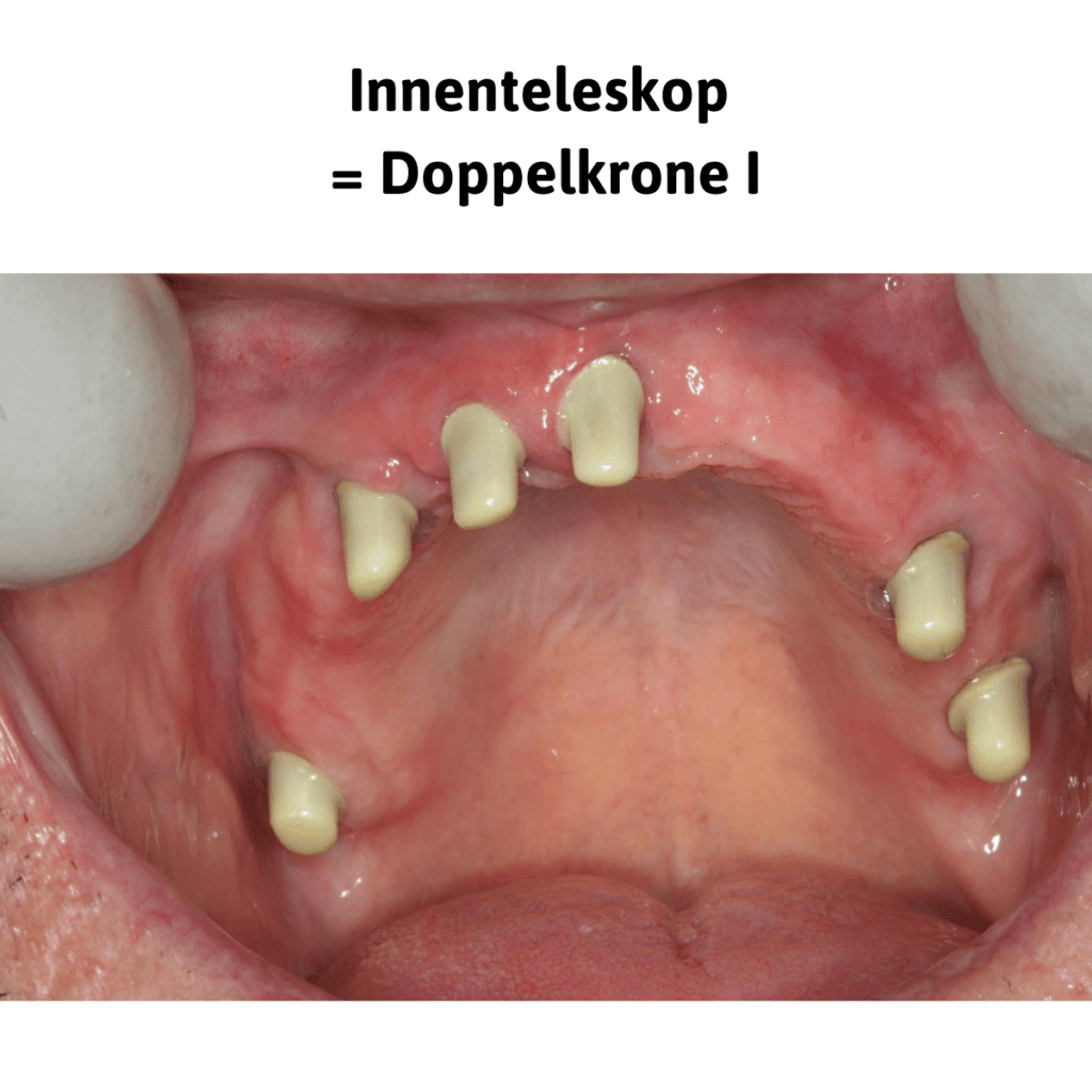 Innenteleskop = Doppelkrone I