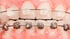 Nahaufnahme von Zähnen mit Keramik-Brackets oben und Metall-Zahnspange unten zur kieferorthopädischen Korrektur.