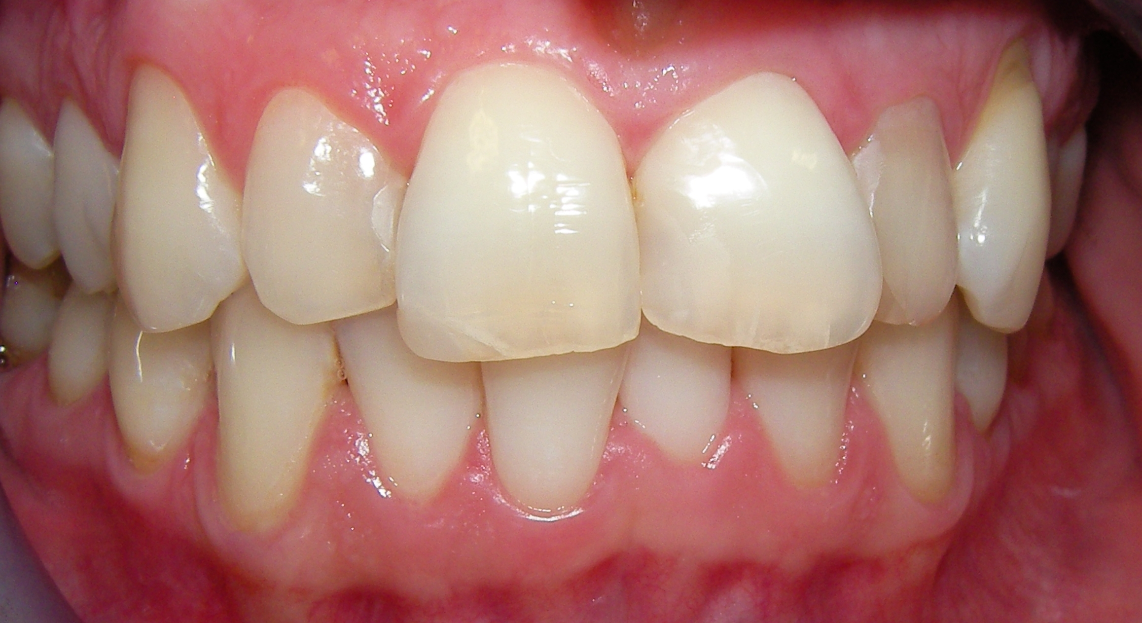 Veneers – Vorher