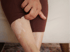 Person scratches a scar on their leg from autoimmune disease.