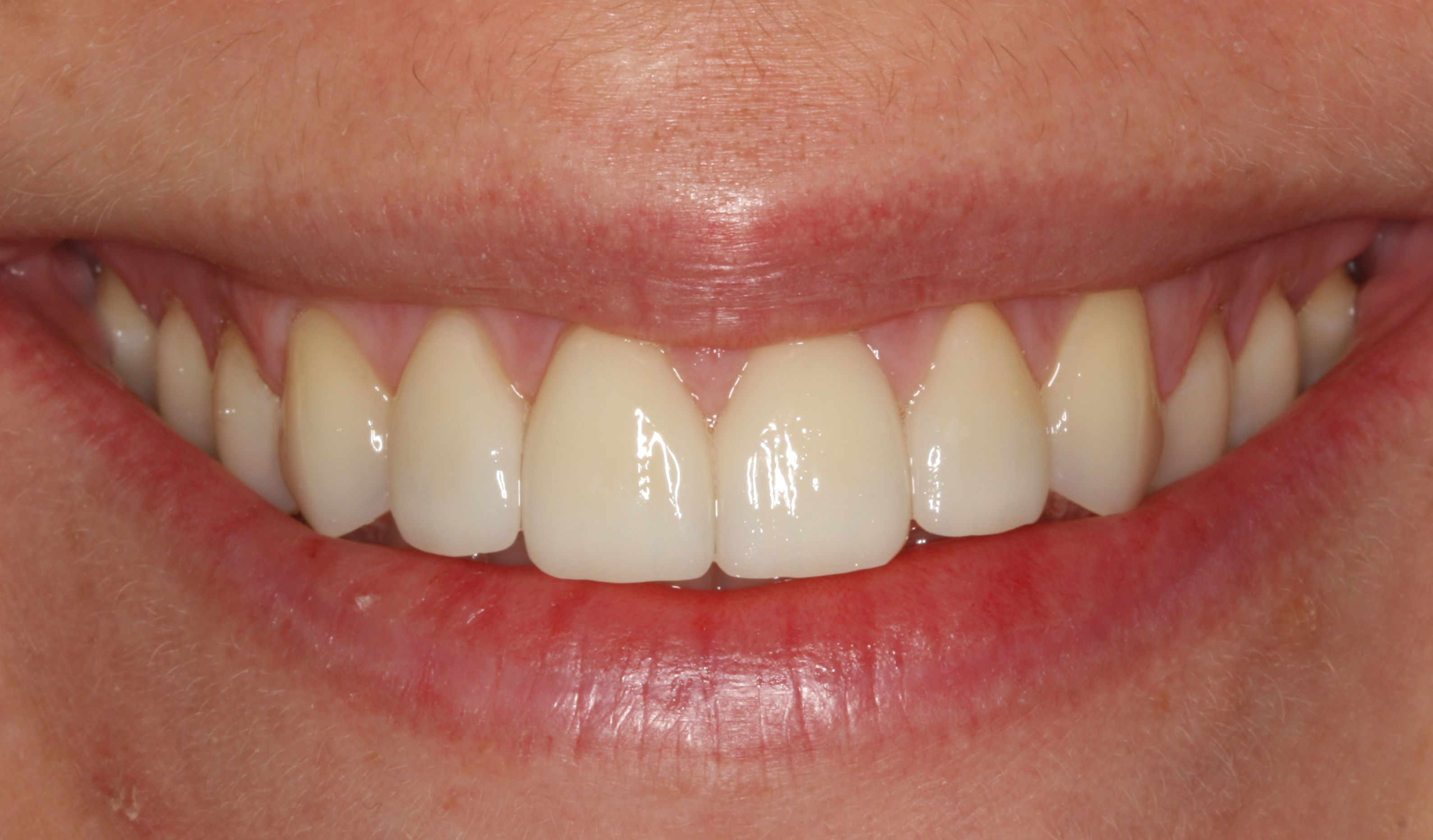 Veneers – Nachher