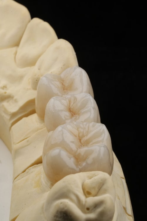 Dentalfoto: Kronen auf dem Modell