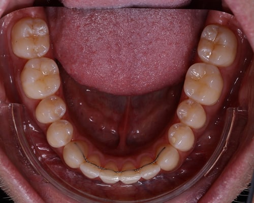 Dentalfoto: Unterkiefer okklusal