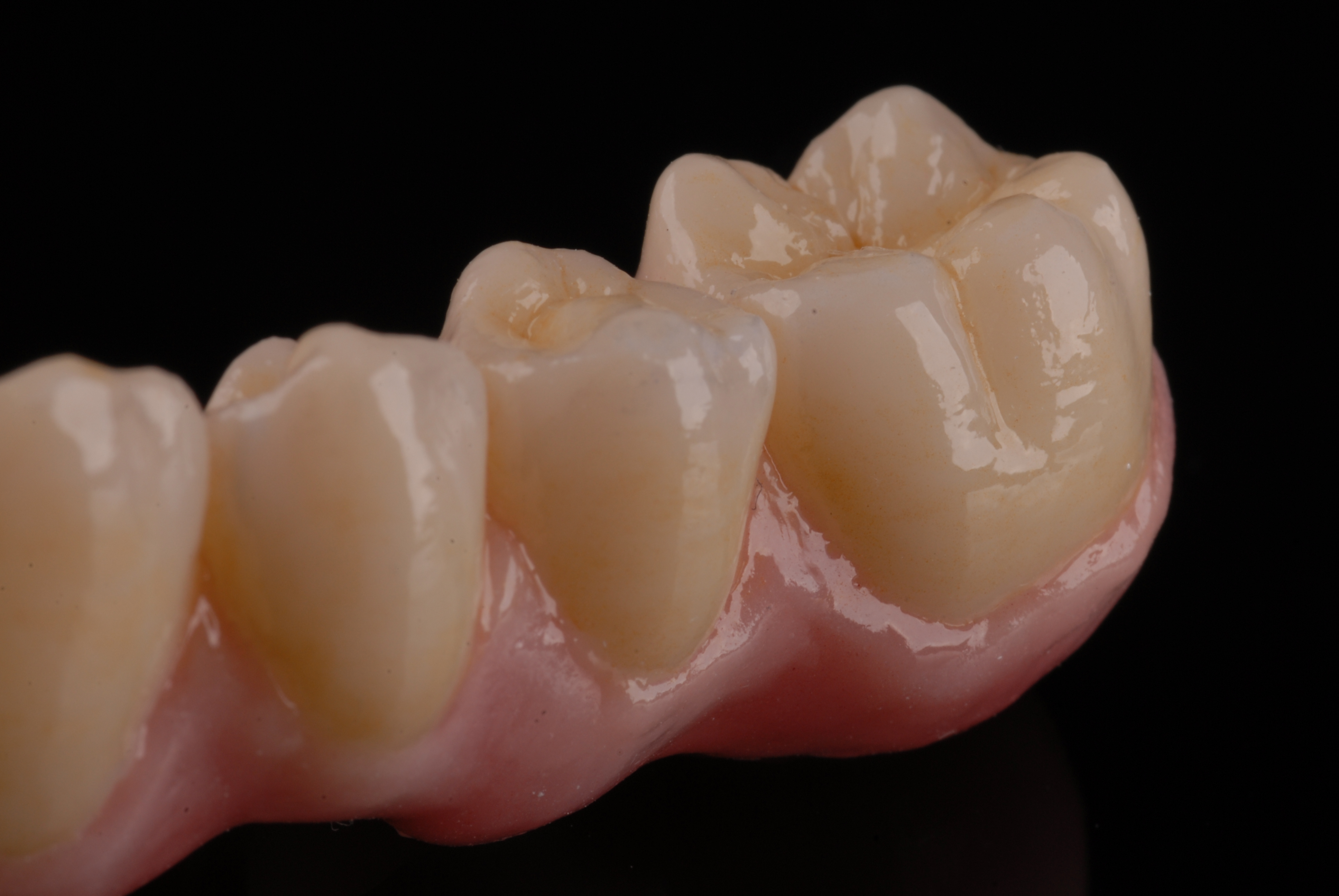 Nahaufnahme einer Zirkonarbeit im Unterkiefer von ADU-Dental