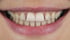 Unschöne Zähne ohne Veneers