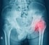 Hip Pain Treatment in Columbia