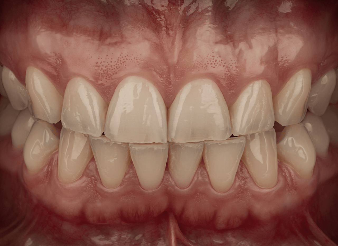 Dentalfoto: Frontzähne in Nahaufnahme