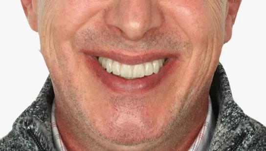 Verschraubte Versorgung nach Einsatz der geteilten Bohrschablone von ADU-Dental